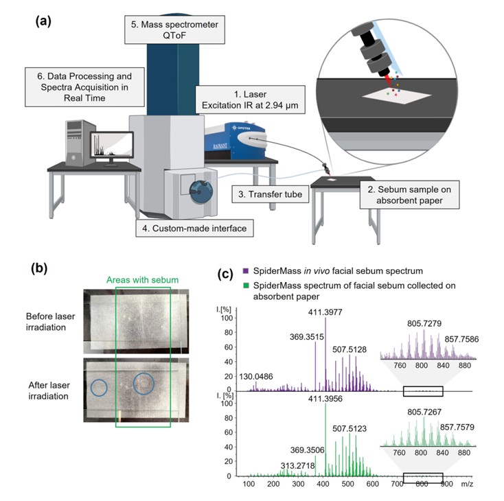 Lipidomic Insights into Seborrheic Dermatitis: Clinical Evaluation of Sebum Changes Using SpiderMass